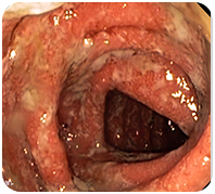VIÊM LOÉT ĐẠI TRÀNG