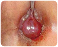 Trước khi điều trị trĩ